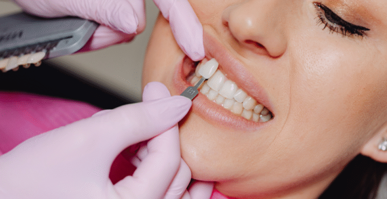 Ceramic Veneers: A Quick Way to Upgrade Your Smile