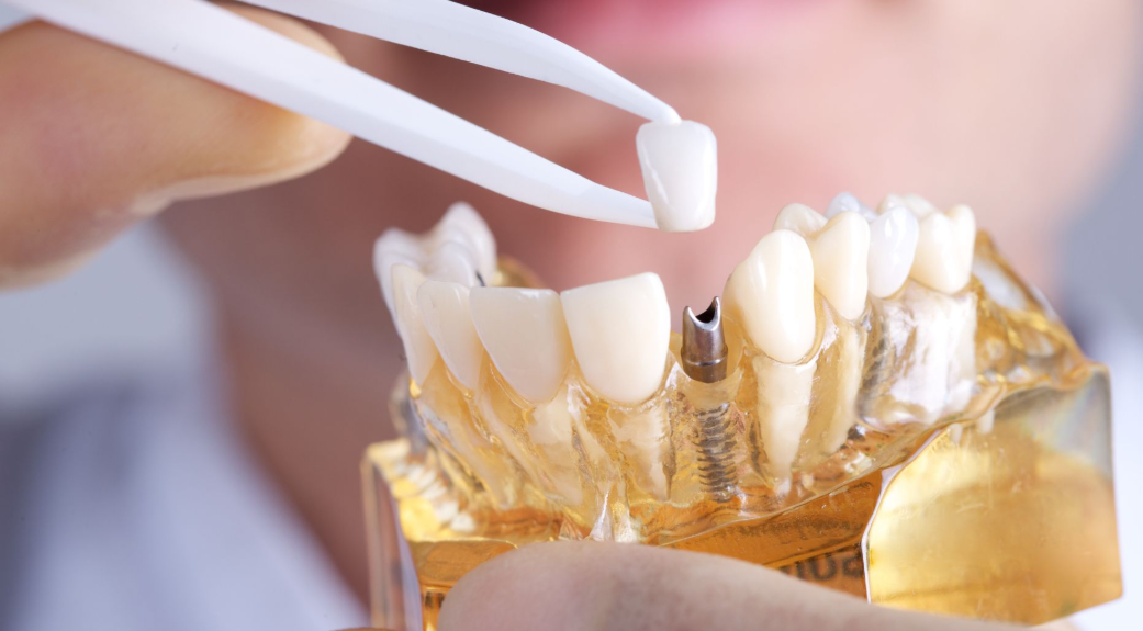 The Process of Getting Dental Implants